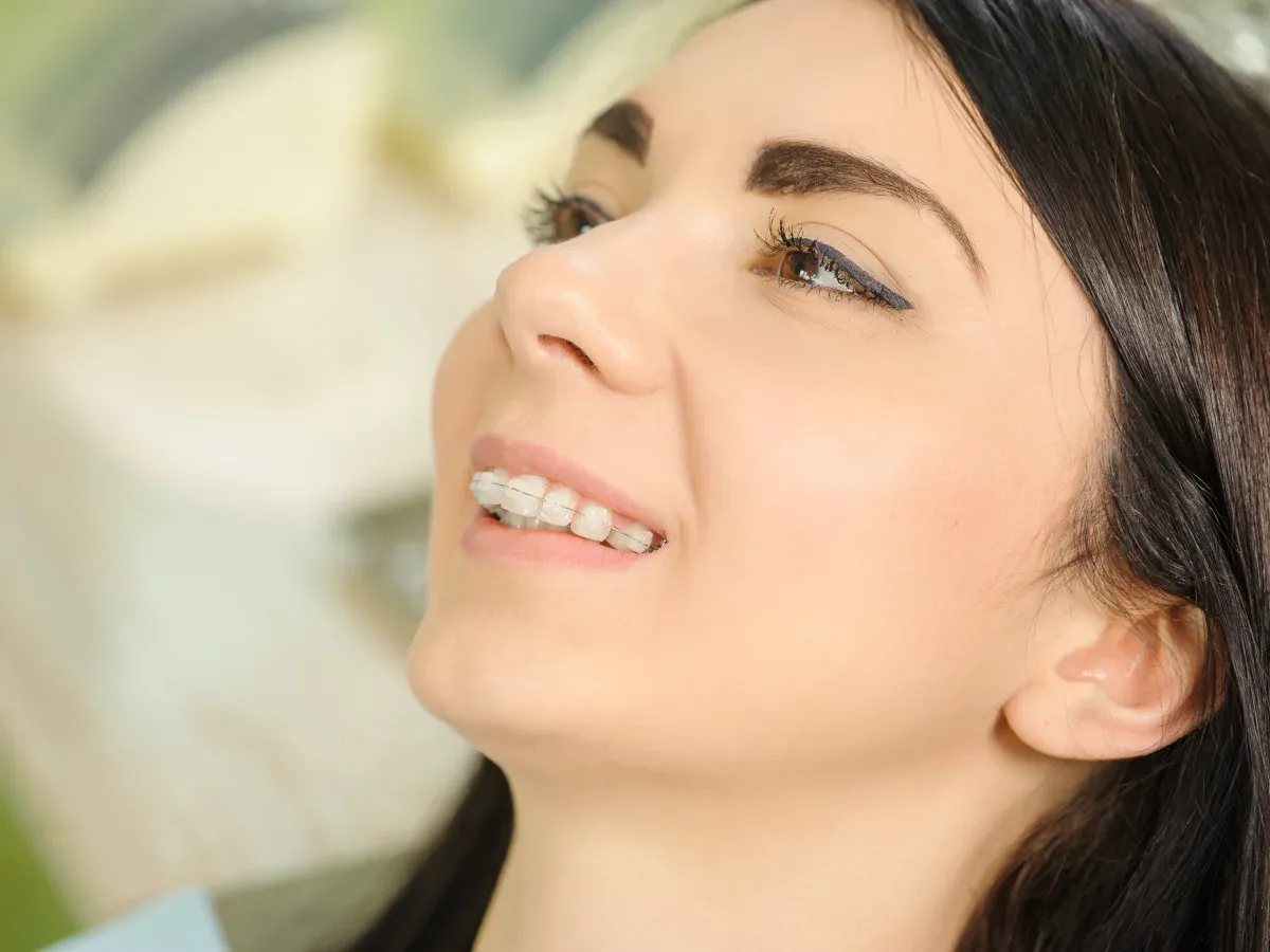 Ceramic braces Ceramic braces