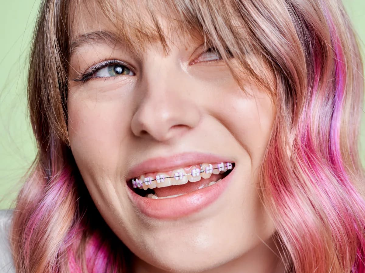 LightForce™ Custom Braces LightForce™ Custom Braces
