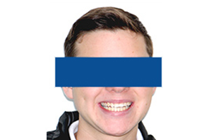 Orthodontic treatment after Orthodontic treatment after