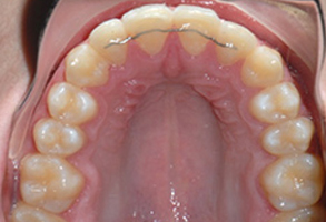 Orthodontic treatment after Orthodontic treatment after