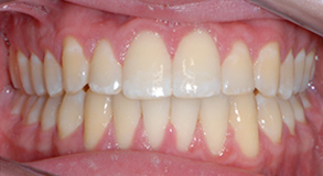Orthodontic treatment after Orthodontic treatment after