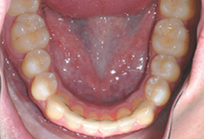 Orthodontic treatment after Orthodontic treatment after