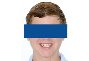 Orthodontic treatment before Orthodontic treatment before