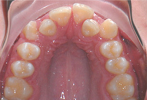 Orthodontic treatment before Orthodontic treatment before
