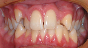 Orthodontic treatment before Orthodontic treatment before