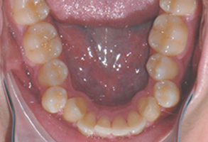 Orthodontic treatment before Orthodontic treatment before