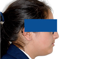 Orthodontic treatment after Orthodontic treatment after