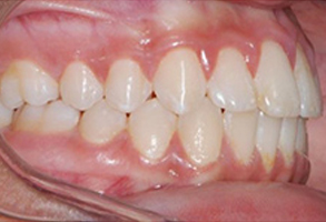 Orthodontic treatment after Orthodontic treatment after