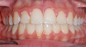 Orthodontic treatment after Orthodontic treatment after