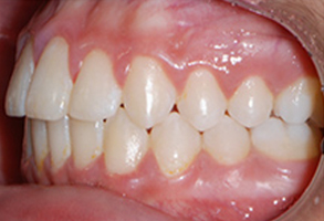 Orthodontic treatment after Orthodontic treatment after