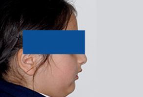 Orthodontic treatment before Orthodontic treatment before