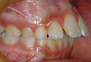Orthodontic treatment before Orthodontic treatment before