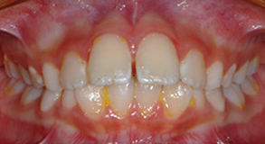 Orthodontic treatment before Orthodontic treatment before