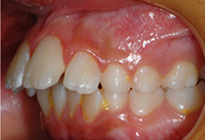 Orthodontic treatment before Orthodontic treatment before