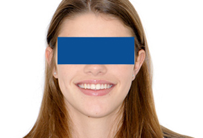 Orthodontic treatment after Orthodontic treatment after