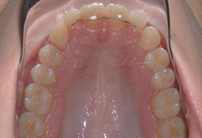 Orthodontic treatment after Orthodontic treatment after