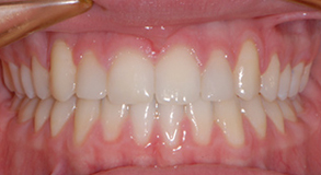 Orthodontic treatment after Orthodontic treatment after
