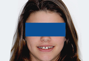 Orthodontic treatment before Orthodontic treatment before