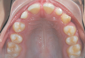 Orthodontic treatment before Orthodontic treatment before