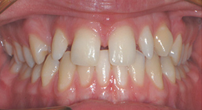 Orthodontic treatment before Orthodontic treatment before