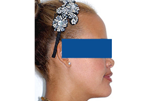 Orthodontic treatment after Orthodontic treatment after