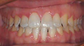 Orthodontic treatment after Orthodontic treatment after