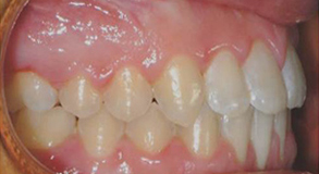 Orthodontic treatment after Orthodontic treatment after