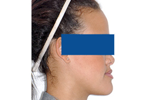 Orthodontic treatment before Orthodontic treatment before