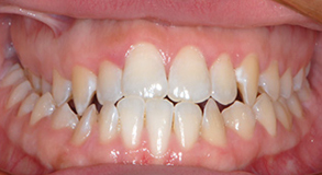 Orthodontic treatment before Orthodontic treatment before