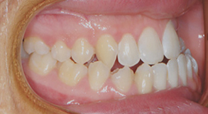 Orthodontic treatment before Orthodontic treatment before